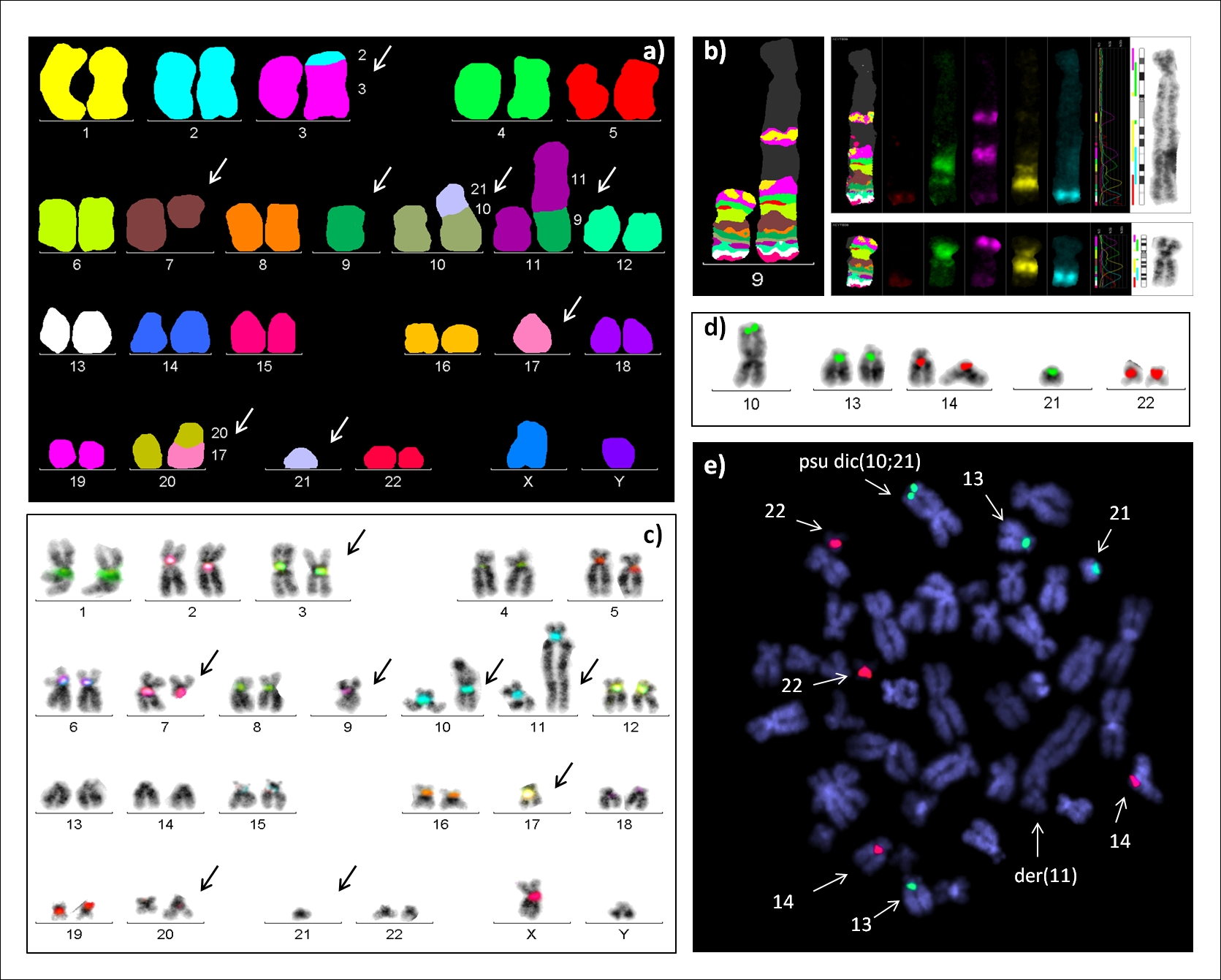 Molecular-cytogenetic analysis of AML patient with complex karyotype: