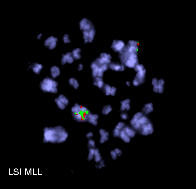 Pathological chromosomes of bone marrow cell of female with acute myeloid leukemia